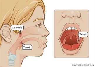 adenoid pic